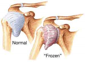 frozen-shoulder1